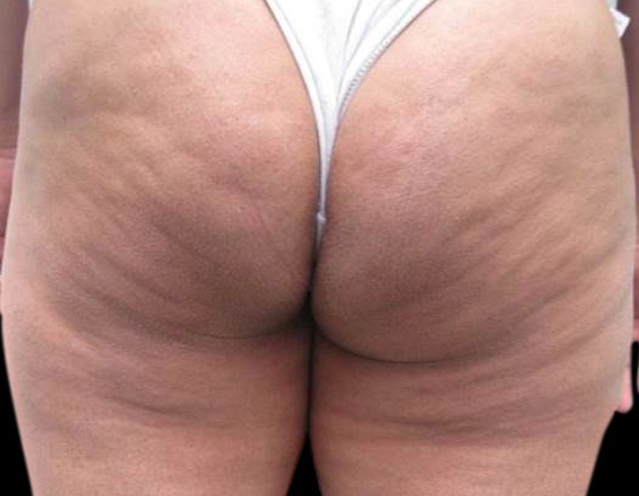 튠 바디를 이용한 셀룰라이트 치료 .. Before