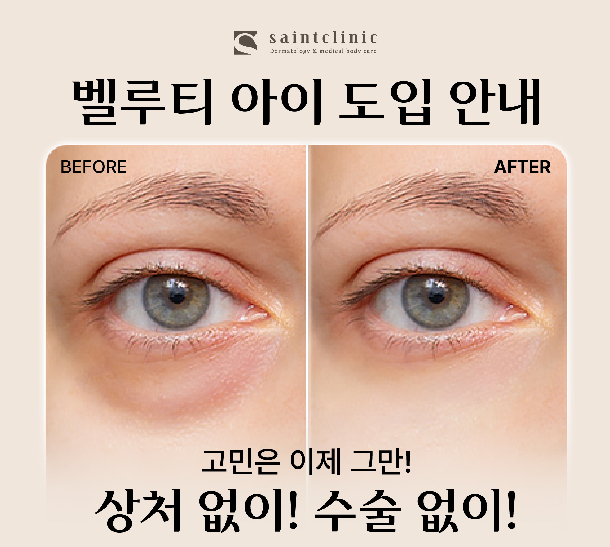 <strong style='font-weight:bold;'>벨루티 레이저 리프팅 도입 안내..</strong>