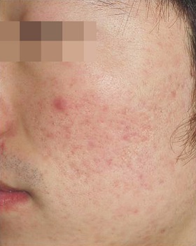 더마블레이트 이펙트 + 알라딘 필링 시술 후 사진