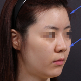 얼굴 지방이식 시술 전 사진