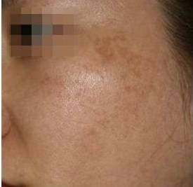 기미 치료 시술 전 사진