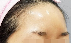 이마필러 시술 후 사진