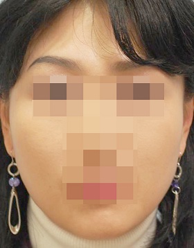 턱보톡스 시술 후 사진