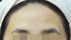 이마 필러 시술 전 사진