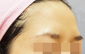 이마필러 시술 전 사진
