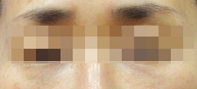 눈물고랑 필러 시술 후 사진