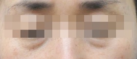 눈물고랑 필러 시술 전 사진