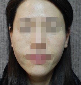 레이저 토닝 시술 후 사진