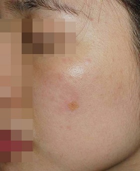 오타양 모반 : 엔디야그 색소 레이저 시술 후 사진