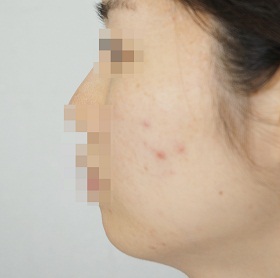 턱끝 필러 시술 전 사진