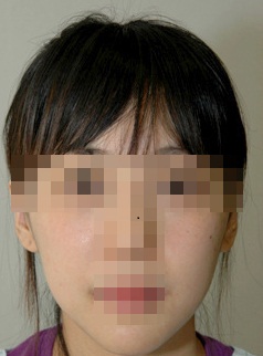 볼 지방이식 시술 전 사진