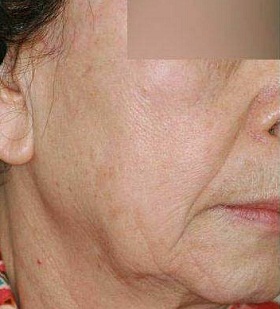 실리프팅 시술 전 사진