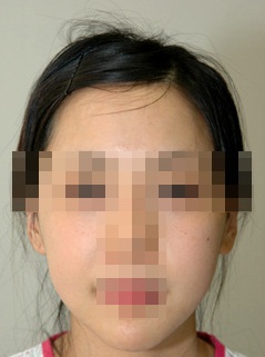 볼 지방이식 시술 후 사진
