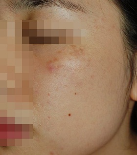 오타양 모반 : 엔디야그 색소 레이저 시술 전 사진