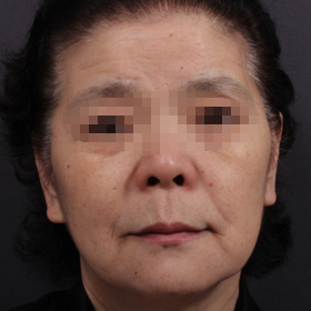 실리프팅 시술 전 사진