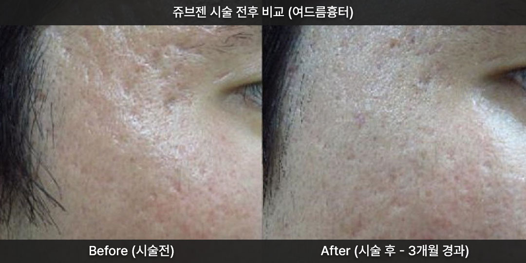 쥬브젠 추천 대상