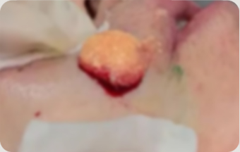 캐뉼라를 이용한 흡입