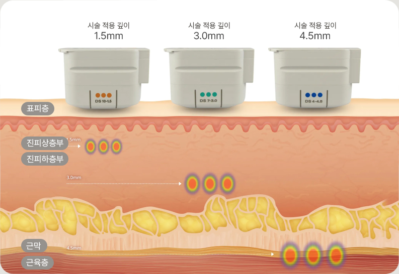 울쎄라는 SMAS층까지 전달하여 치료합니다